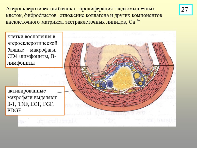 Атеросклеротическая бляшка - пролиферация гладкомышечных клеток, фибробластов, отложение коллагена и других компонентов внеклеточного матрикса,